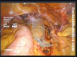 Figure 1. Mesh sacralcolpopexy for recurrent vaginal vault prolapse