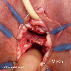 Picture 3 - Post wall mesh isolated at beginning of dissection 