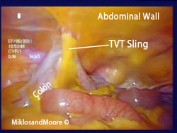 Picture 1:  Sigmoid Colon pulled up to the Abdominal Wall