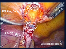 Picture 2:  Cutting the mesh away from the Abdominal Wall
