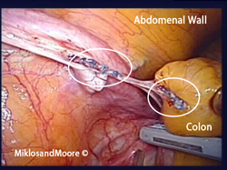 Picture 4:  Picture of the released bowel with the old TVT sling going through and through  the bowel. This area of bowel had to be removed and resected.