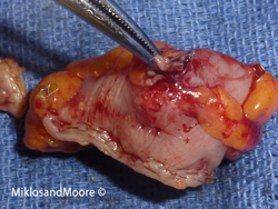 Picture 5  & 6: Pictures of the removed piece of bowel with the TVT mesh  penetration.