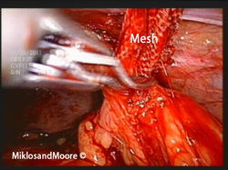  The mesh is seen in the middle of the picture and has been dissected off of the tailbone.