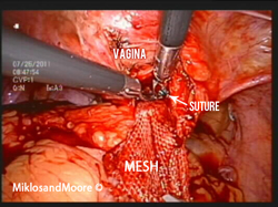 The mesh is again seen in the middle of the picture with both instruments being utilized to remove the sutures that are holding the mesh to the vagina.
