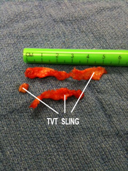  Mesh covered with peritoneum (the skin lining the abdominal cavity).