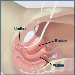  Mesh covered with peritoneum (the skin lining the abdominal cavity).