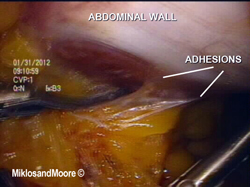 Adhesions are identified and cut using scissors