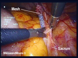 Figure 4 - The peritoneum is incised to access the sacral colpopexy mesh