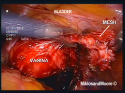 Figure 7 - The mesh is dissected away from the vagina