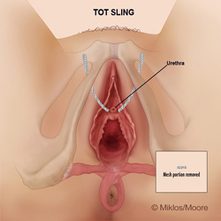 Mesh Complications Case Study 5-2