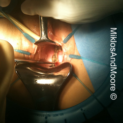 Vaginal Approach to Sacralcolpopexy mesh removal