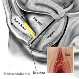 Mini Sling Erosion into Urethra