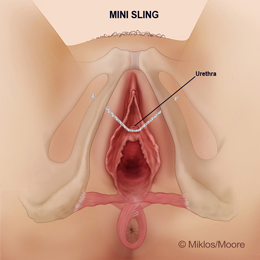 Outward tension causing vaginal pain