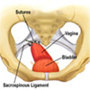 Sacrospinous Ligament Complications