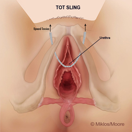Upward tension - obstructing urethra