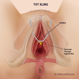 Extrusion of mesh through vaginal skin