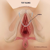 Mesh erosion in urethra / bladder