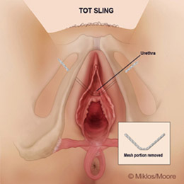 Portion of mesh removed to relieve tensionn