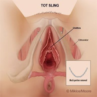 Drs. Miklos & Moore TOT removal for vaginal pain