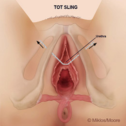 Outward tension causing Groin Pain