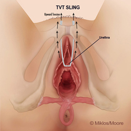TVT Sling blocking urethra