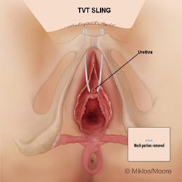 TVT Portion blocking urethra removed