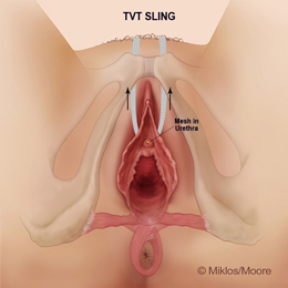 TVT Sling Erosion into Urethra